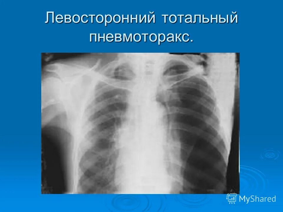 Разрыв легочной. Двусторонний пневмоторакс рентген. Тотальный пневмоторакс рентген. Пневмоторакс рентген снимки. Правосторонний Тотальный пневмоторакс.