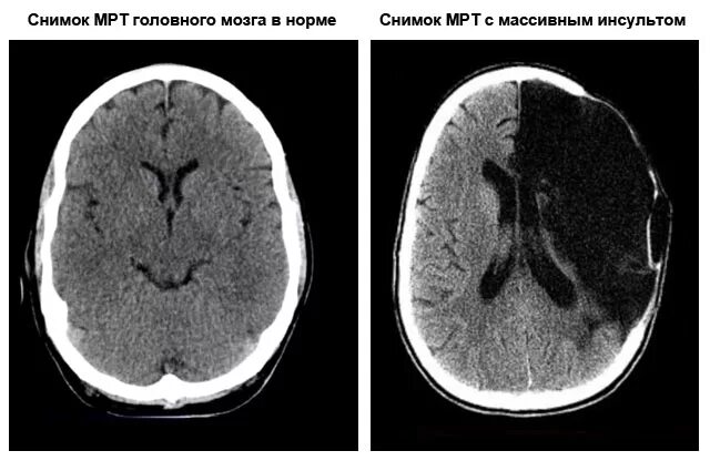 Геморрагический инсульт височной доли. Ишемический инсульт снимок кт. Мрт снимки ишемического инсульта. Геморрагический инсульт головного мозга кт.