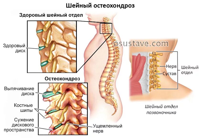 Лечение острого остеохондроза. Шейный остеохондроз. Остеохондроз шейного отдела позвоночника. Шейный остеохондроз отде. Начальный остеохондроз шейного отдела позвоночника.