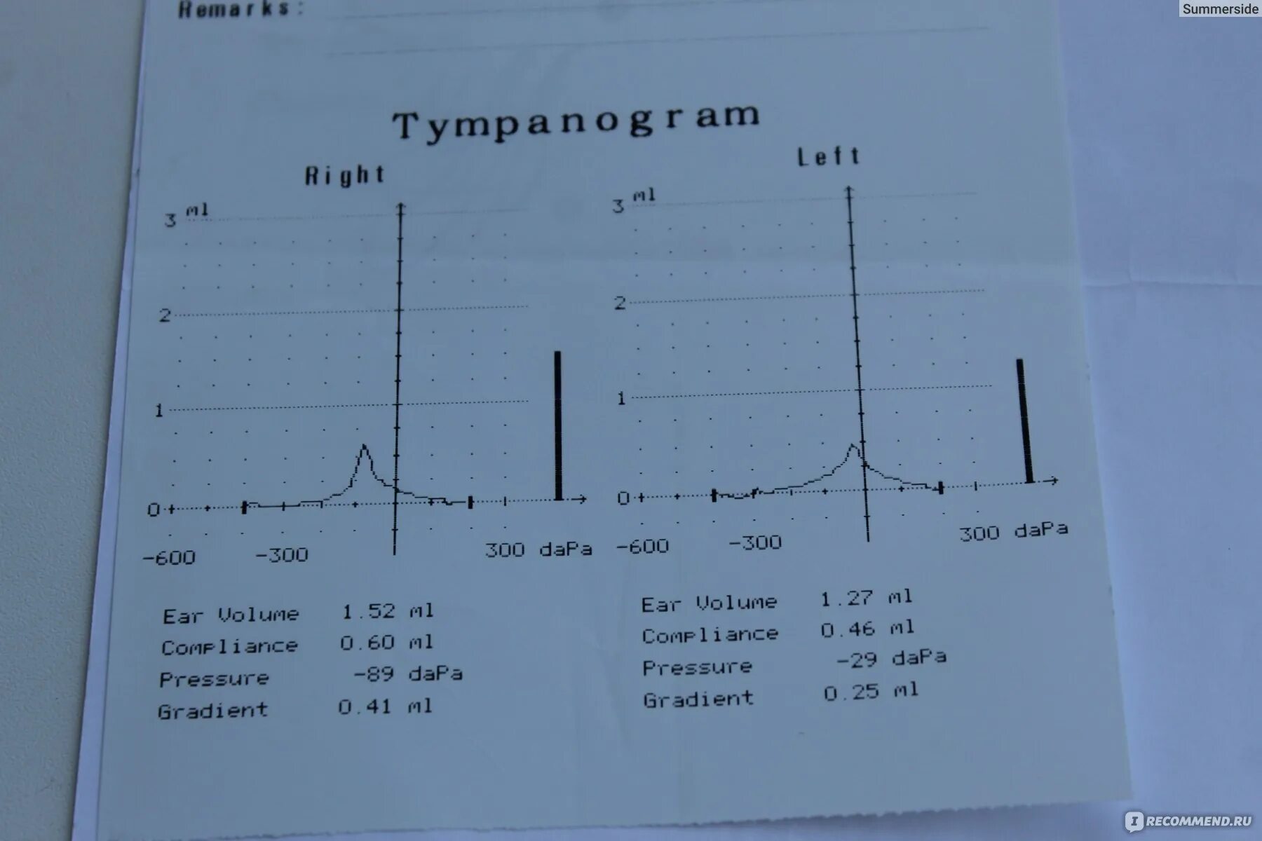 Тимпанограмма тип а. Тимпанограмма слуха у детей норма. тимпанометрия показатели нормы. тимпанограмма слуха расшифровка у детей. тимпанограмма тип с.