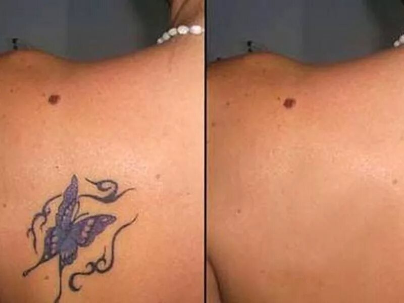 Результаты сведения тату лазером. Выводят тату лазером. Выводят тату лазером. Выводят тату лазером. Выведение татуировок лазером.