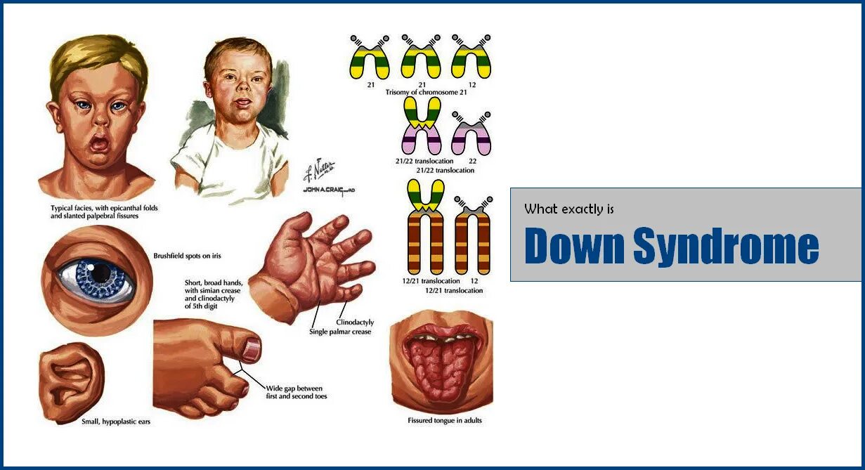 Disease syndrome. Disease syndrome. Кушинг синдром у женщин. Disease syndrome. Ожирение метаболический синдром.