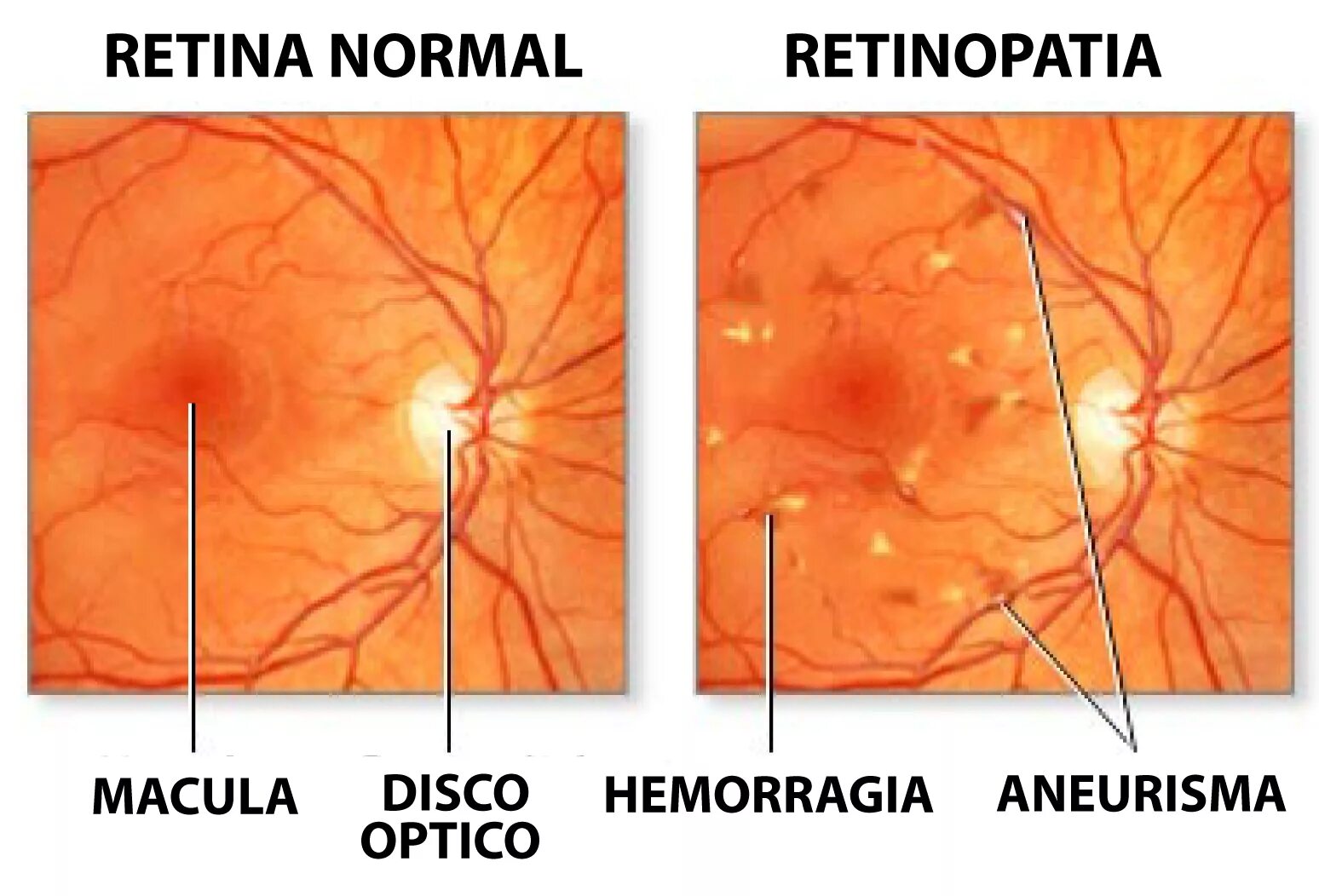 Гипертоническая ретинопатия глазное дно. Диабетическая ретинопатия глазное дно. Диабетическая ангиопатия глазное дно. Ангиопатия и ретинопатия сетчатки.