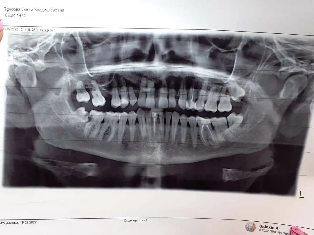 Снимок зубов видное. Панорамный снимок зубов. Панорамные снимки зубов на бумаге. Панорамный снимок зубов пульпит.
