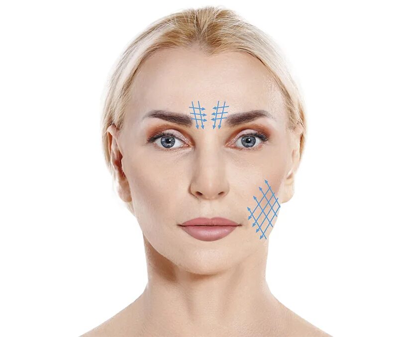 Тредлифтинг 3d мезонитями. Нитевой лифтинг. Нити субментальная зона. Мезонити интрарич. Нитевой лифтинг зоны.