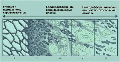 Шкала глиссона при раке