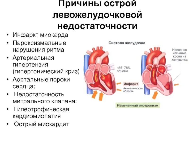 Сердечная недостаточность при инфаркте миокарда. Хроническая левожелудочковая сердечная недостаточность патогенез. ХСН правожелудочковая недостаточность. Острая левожелудочковая недостаточность гемодинамика. Левожелудочковая недостаточность схема.