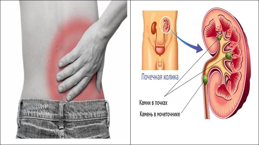 Боль и ноет в почках. Застудил почки симптомы.