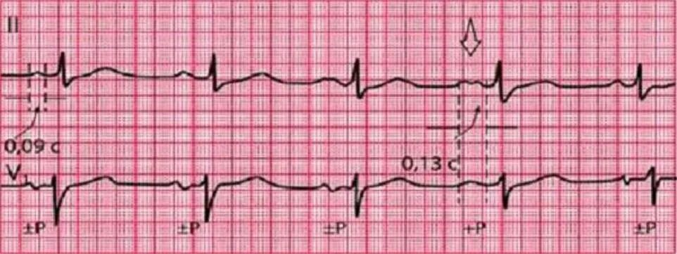 Что значит внутрипредсердная внутрипредсердная блокада. Внутрипредсердная блокада на ЭКГ. ЭКГ при внутрипредсердной блокаде. Межпредсердная блокада 3 степени ЭКГ. Внутрипредсердные блокады на ЭКГ.