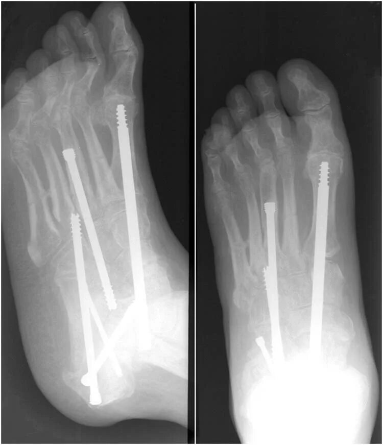 Эндопротезирование пястных костей. Артродезирование сустава пальца стопы. Эндопротезирование плюснефалангового сустава. Эндопротез пястно-фалангового сустава. Эндопротезирование первого плюснефалангового сустава.