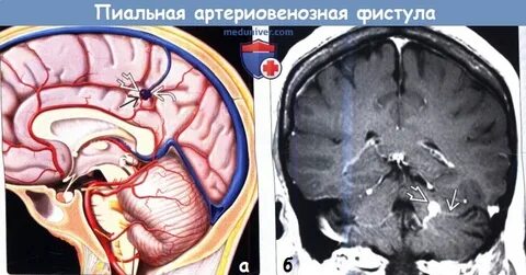 Фистула сосуда