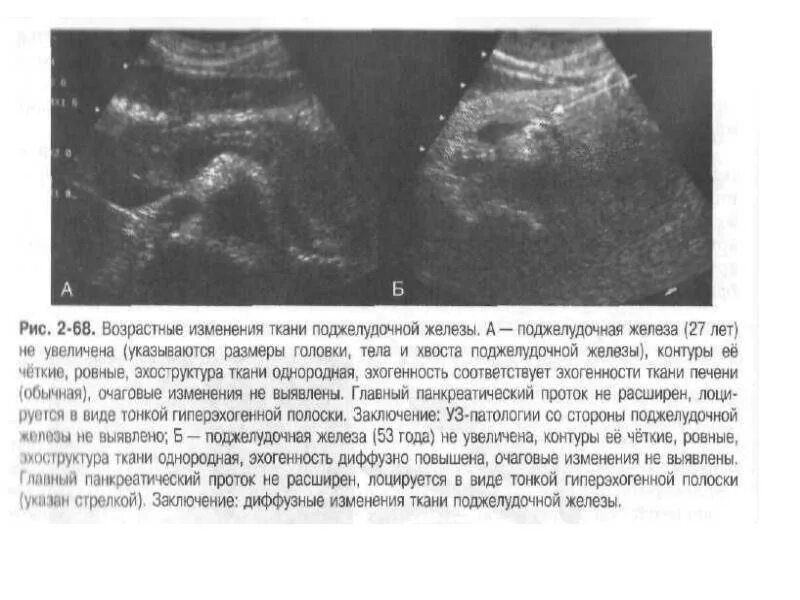 Чем опасны диффузные изменения. Паренхима-УЗИ поджелудочной железы. Диффузные изменения поджелудочной железы на УЗИ. Изменения паренхимы поджелудочной железы что это такое. Диффузные изменения поджелудочной железы что это.