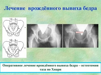Врожденный подвывих