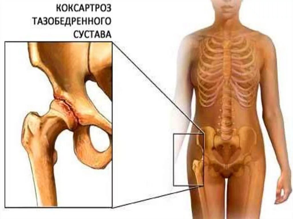 Тазобедренный отдает в поясницу. Артрит коксартроз тазобедренного. Шейка бедра коксартроз. Артрит тазобедренного сустава. Коксит тазобедренного сустава.