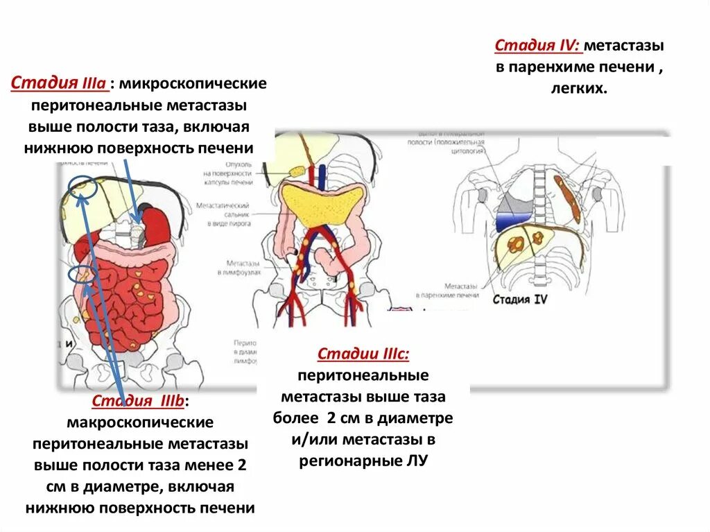 Перитонеальные метастазы. Метастазы макроскопич. Перитонеальных макроскопических метастазов. Перитонеальная поверхность печени. Онкология 4 стадия форум