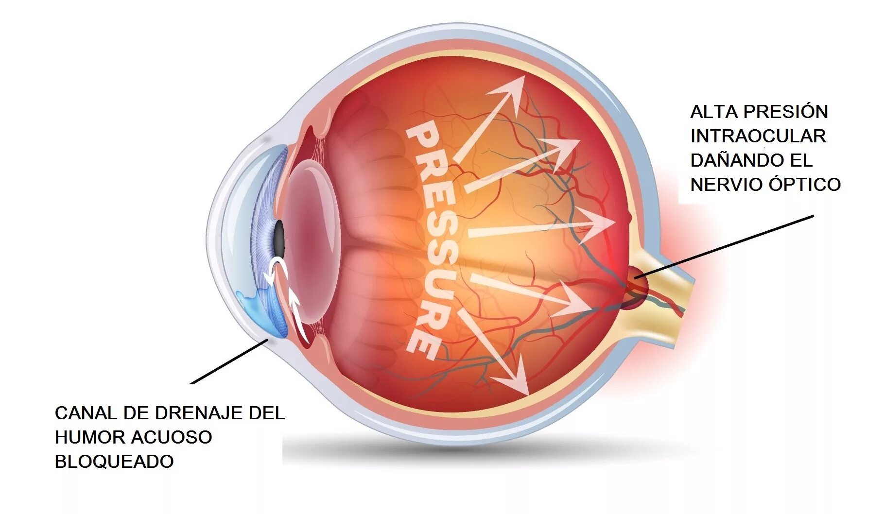 Краеугольная глаукома. Глаукома псевдонормального давления. Glaucoma Drainage. При глаукоме можно применять