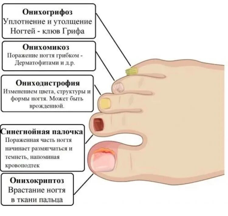 Почему ногти становятся жесткими. Инфекционные заболевания ногтей. Болезни ногтей на руках таблица. Причины болезни ногтей на ногах.