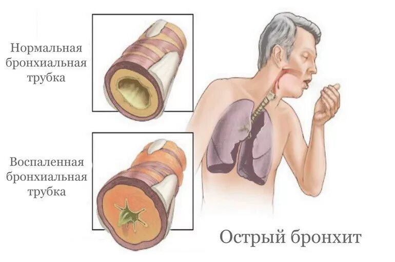 Трахеобронхит лечение у взрослых с кашлем. Острый бронхит симптомы. Бронхит и острый бронхит. Острые заболевания бронхов. Острый и хронический бронхит.