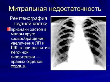 Митральная недостаточность