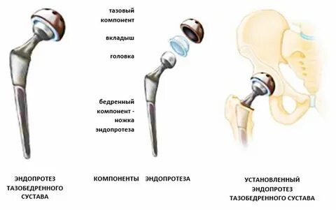 Бесцементное эндопротезирование тазобедренного сустава