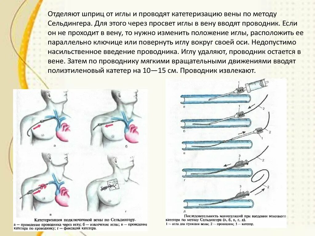 Уход за подключичным катетером. Методика Сельдингера катетеризация. Метод пункции подключичной вены по Сельдингеру. Пункция подключичной вены по методике Сельдингера. Катетеризация вен по Сельдингеру.