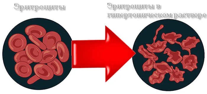 Эритроциты в растворе хлорида натрия. Гипертонический раствор эритроциты. Эритроциты помещенные в гипертонический раствор. Гипертонический раствор эритроцуи. Сморщивание эритроцитов в гипертоническом растворе.