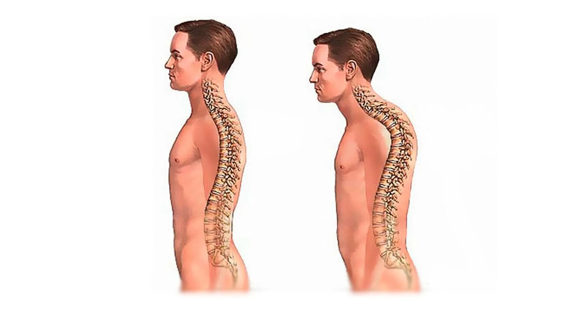 Кифоз грудного отдела позвоночника кифоз. Искривление грудного отдела позвоночника кифоз. Кифоз шейного отдела позвоночника. Кифоз и сколиоз шейного отдела позвоночника. Хрущу поясницей