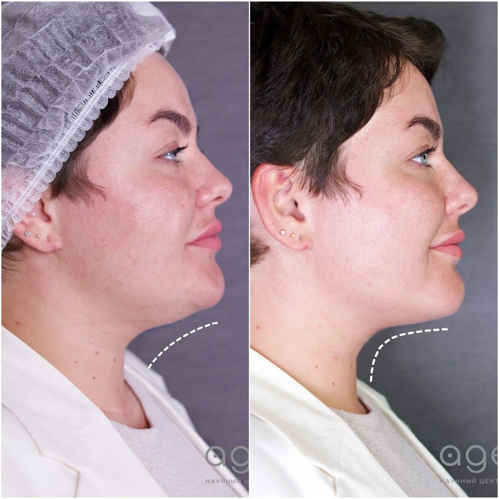 8 подбородок. Профиль лица. Красивые лица девушек без макияжа. Второй подбородок на прозрачном фоне. Упражнения от обвисшего подбородка.