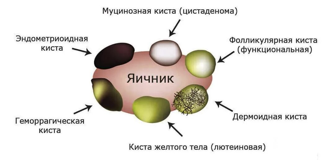 Строение фолликулярной кисты. Функциональные кисты яичников. Фолликулярная (функциональная) киста. Фолликулярные кисты яичников симптомы.