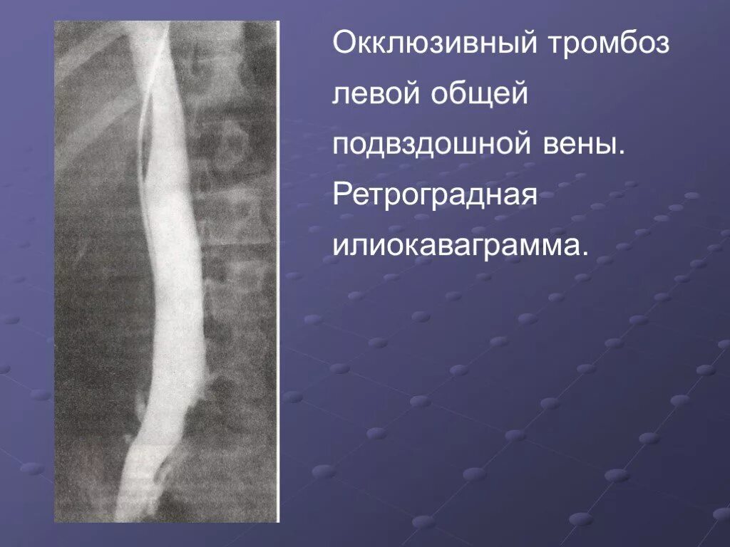 Тромб подвздошной вены. Тромб в подвздошной Вене. Тромбоз общей подвздошной вены. Тромбоз подвздошной вены