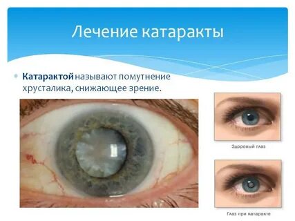 После замены хрусталика в глазу туман причины