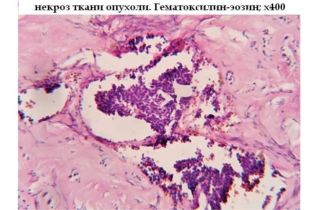 Что такое некроз тканей - CollectPhoto.ru