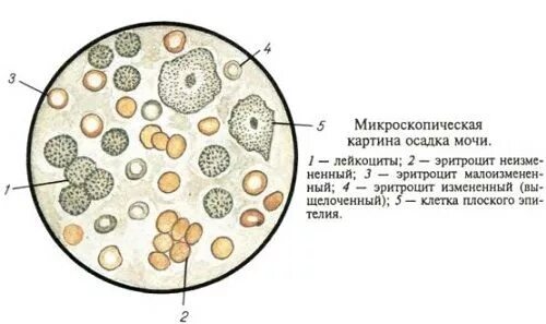 В моче много эритроцитов и лейкоциты. В моче много эритроцитов и лейкоциты