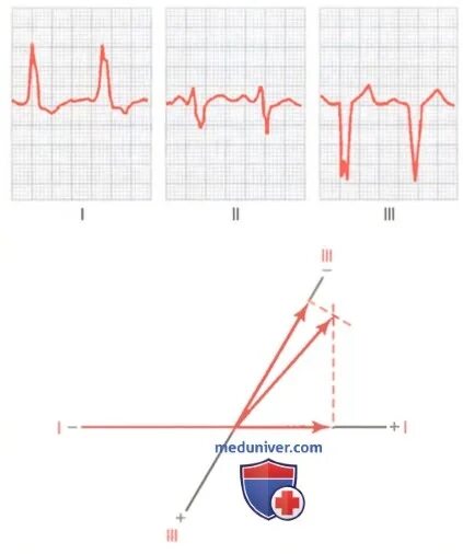 Вольтаж ЭКГ норма. ЭКГ отклонение параметров QRS 111. Высокий зубец т на ЭКГ. Вольтаж комплексов QRS на ЭКГ. Нарушение реполяризации передне перегородочной области