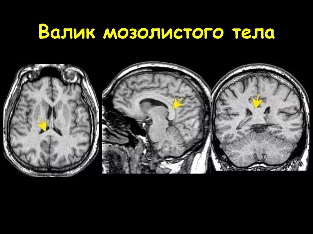 Синдром маркиафавы-биньями. Аномалии мозолистого тела мрт. Глиобластома кт картина. Мозолистое тело анатомия мрт. Мрт головного мозга мозолистое тело.