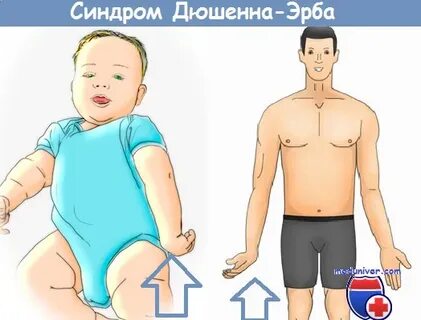 Парез эрба