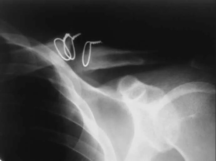 ложный сустав при переломе ключицы. ложный сустав ключицы. перелом ключицы рентген пластины. сросшийся перелом ключицы рентген. врожденный ложный сустав ключицы.