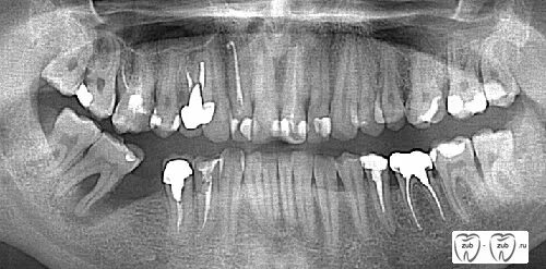 Пародонтальный костный карман это. Пародонтальный карман рентген. Пародонтальный абсцесс. Периодонтальный карман на рентгене. Удаление зуба семерки