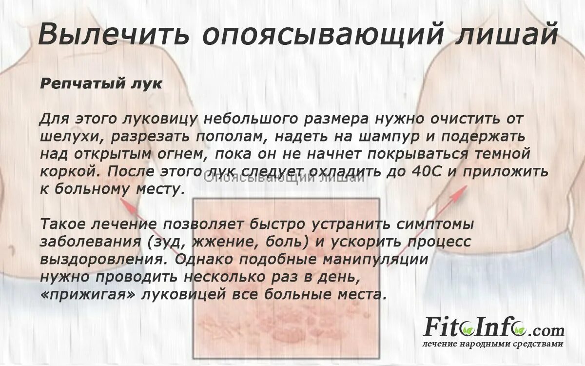 Лечение лишая в домашних условиях народными. Лишай опоясывающий лишай. Опоясывающий герпес сыпь. Для опоясывающего лишая характерно.