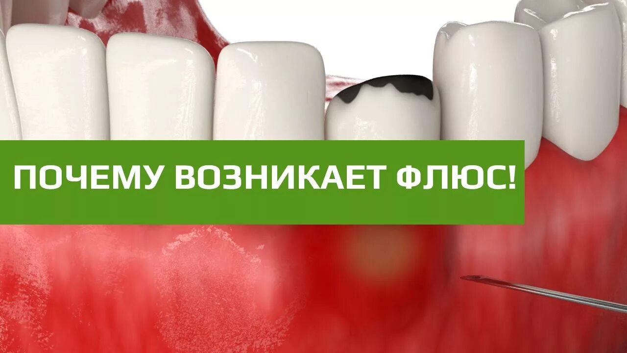 Флюс зуба симптомы и признаки лечение фото Можно удалять зубы при простуде: найдено 82 изображений
