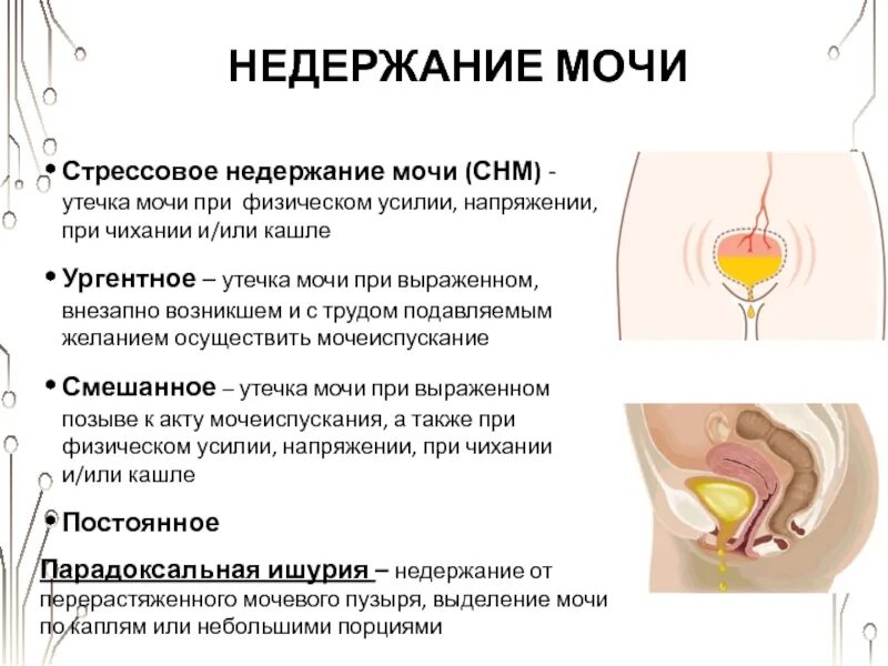 Почему подтекает моча у женщин. Стрессовое недержание мочи. стрессовое и ургентное недержание мочи. подтекает моча у женщин. стрессовая инконтиненция мочи.