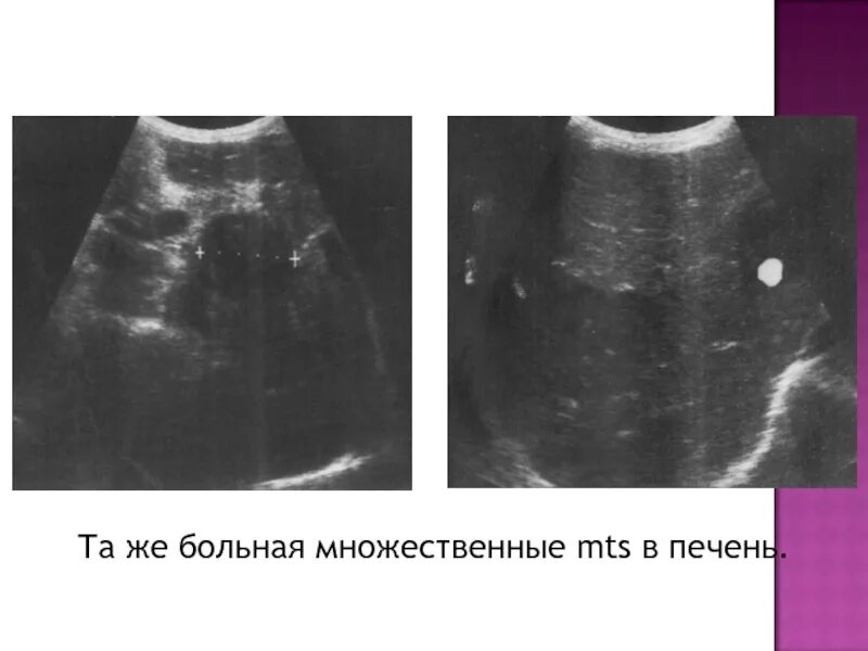 Метастазы в печени на узи. Метастатическое поражение печени узи. множественные метастазы в печени узи. множественные гемангиомы печени. гемангиома поджелудочной железы на узи.