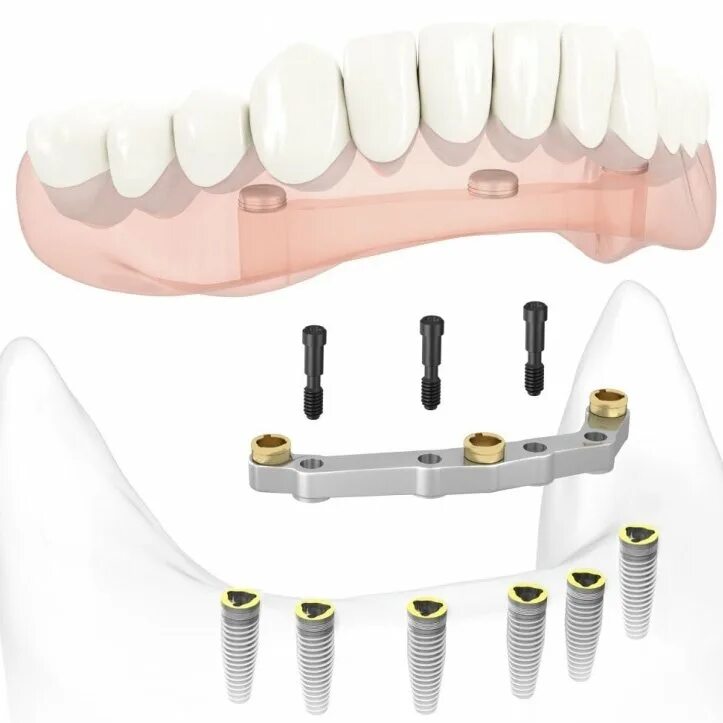 All on 6 цена. Балочная система фиксации на имплантах. Протез съемный балочный на 6 имплантах. Балочная фиксация на имплантах. Балочная фиксация съемных протезов.