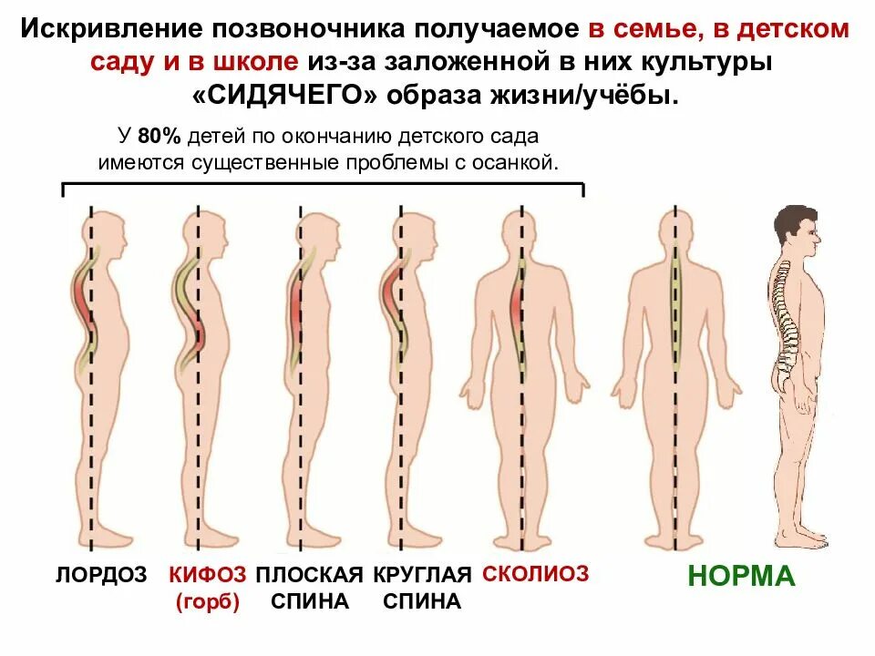 Искривление бывает. Искривление осанки лордотическая. лордоз и кифоз у детей. кифоз лордоз сколиоз различия. искривление позвоночника лордоз кифоз сколиоз.