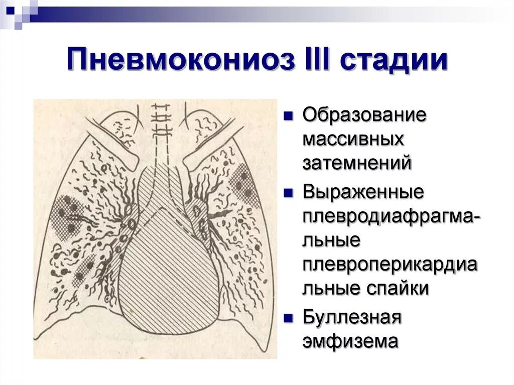 Iii стадия