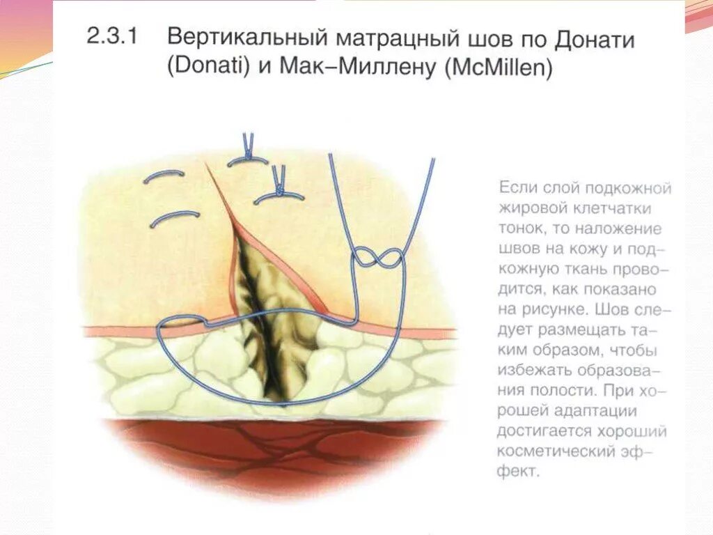 Через сколько рассасываются нити. Вертикальный матрацный шов по Альговеру. Вертикальный матрацный шов Донати. Вертикальный матрацный шов в хирургии. Матрацный хирургический шов.