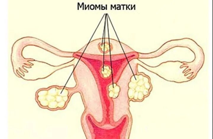 Интрамуральная лейомиома матки. Миомы и фибромиомы матки. Цистоэктомия