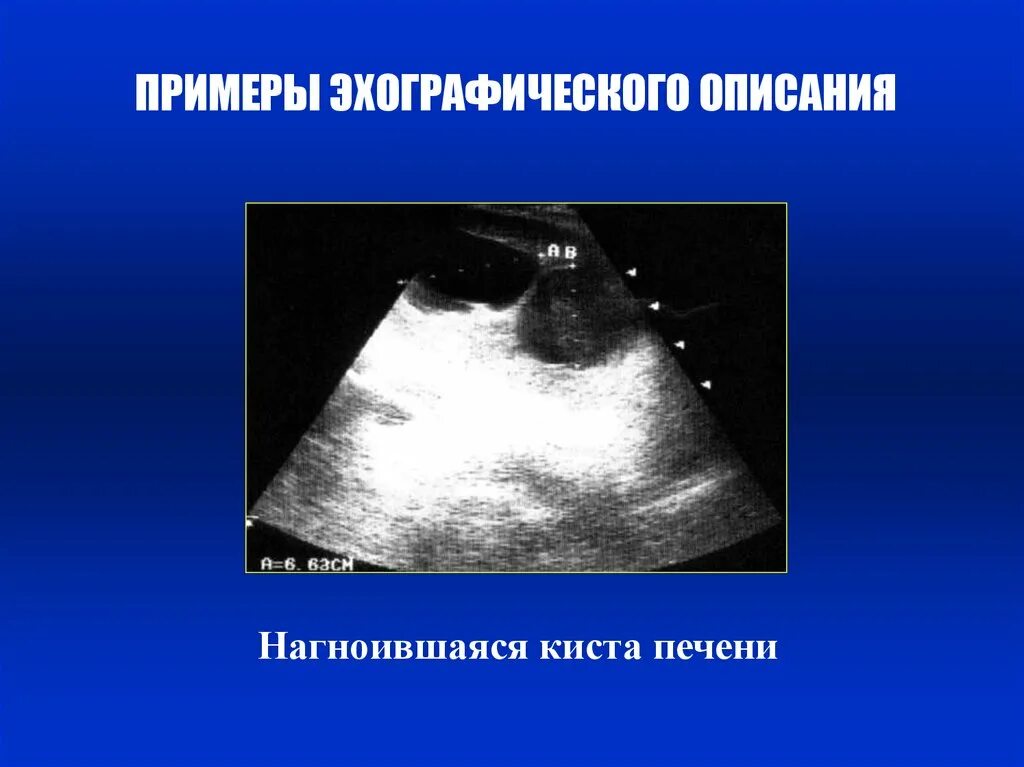 Киста на печени чем опасна у женщины. Многокамерная киста печени УЗИ. Многокамерная киста печени. Киста печени двухкамерная. Травматические кисты печени.