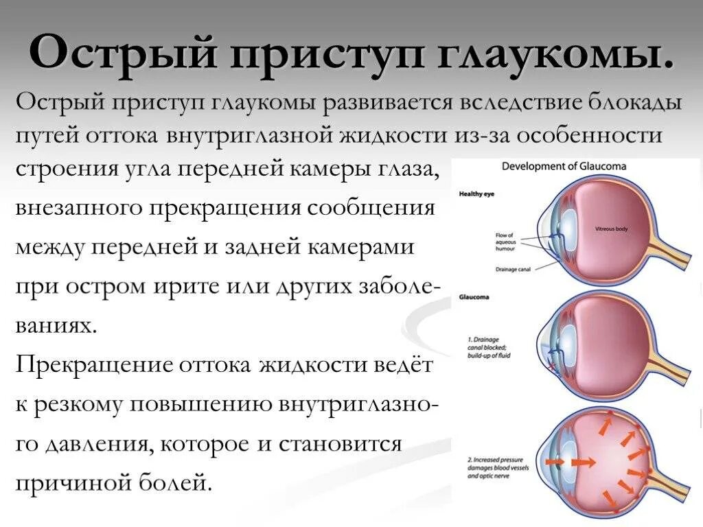 Внутриглазное давление у мужчин. Высокое глазное давление причины. Глаукома причины возникновения.