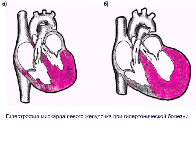Артериальный конус левого желудочка. Гипертрофия миокарда гемодинамика. Гипертрофия миокарда левого желудочка сердца что это такое. Что значит миокард левого желудочка сердца. Гипертрофия миокарда спортивное сердце.